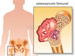 Osteosarcomul
