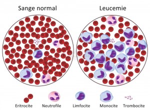 Leucemia mieloidă cronică