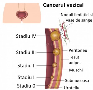 Cancerul de vezica urinara