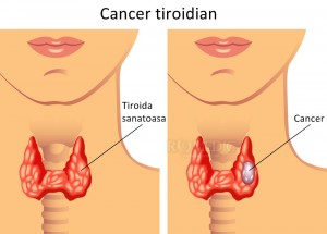Cancerul tiroidian (de tiroidă)