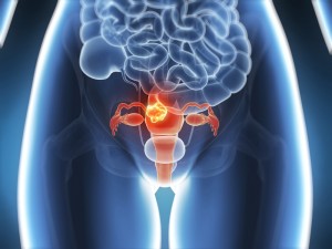 Testarea HPV duce la detectarea și tratarea precoce a pre-cancerului de col uterin