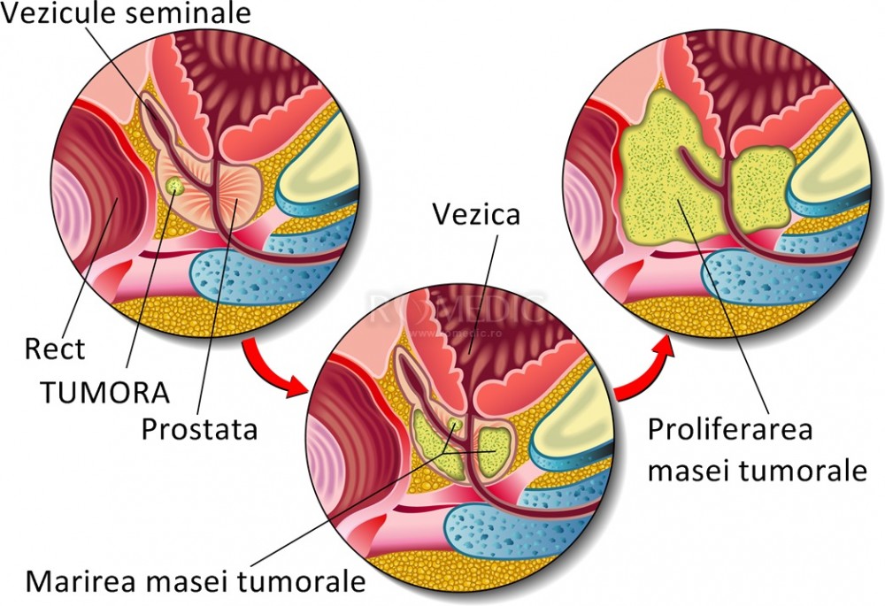 Metastaze date de cancerul de prostata
