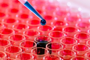Cancerul ductului biliar (Colangiocarcinomul)