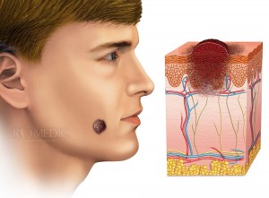Cancerul de piele (melanomul)