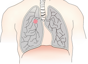 Cancerul pleural