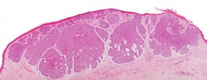 Liposarcomul