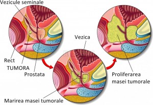 Cancerul de prostată