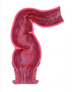 Cancerul rectal