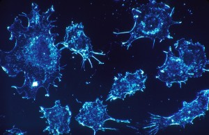 Inteligența artificială, folosită pentru detectarea cancerului colorectal cu precizie de 86%