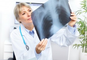 Șansa pacienților cu tumori bronhopulmonare, nerezecabile: Durvalumabul