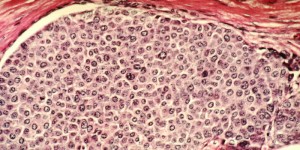 Utilizarea zahărului în terapiile oncologice
