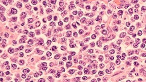 O nanoparticulă sintetică induce moartea celulară în formațiunile canceroase