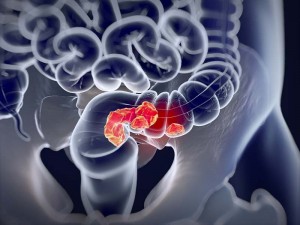 Inteligenţa artificială în detectarea cancerului colorectal