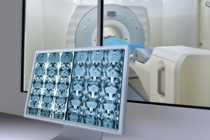 Noua terapie combinată ajută la prelungirea vieții bărbaților cu cancer de prostată