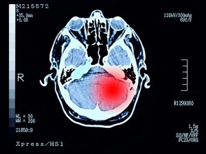 Un studiu proteomic al 2002 tumori identifică 11 subtipuri moleculare din 14 tipuri de cancer