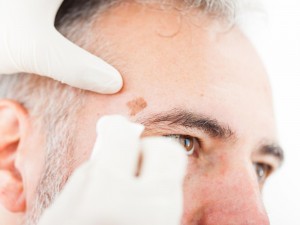 Strategia de medicație combinată activează imunitatea mediată de limfocitele T natural-killer pentru a ataca tumorile