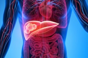 Combinarea radioterapiei cu terapia sistemică prelungește supraviețuirea pacienților cu o formă severă de cancer