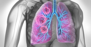 Cercetătorii au dezvoltat un vaccin care ar putea preveni răspândirea metastazelor cancerigene la plămâni