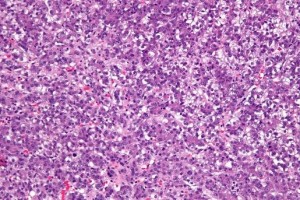 O nouă strategie de tratament și-a dovedit eficiența împotriva unei forme comune de cancer hepatic la copii