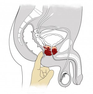 Dieta cetogenă modifică peisajul epigenetic și imunitar al cancerului de prostată pentru a depăși rezistența la terapia de blocare a punctelor de cont