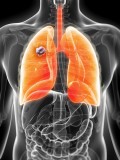 Cancerul pulmonar poate exista în stare latentă în organism chiar și 20 de ani