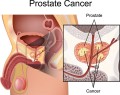 Istoricul de cancer testicular, factor de risc pentru dezvoltarea cancerului de prostată