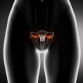 Ovariectomia ar putea crește risul de cancer colorectal