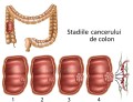 Cancerul colorectal, mult mai frecvent la persoanele cu un stil de viață nesănătos