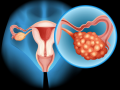 Rolul țesutului adipos senescent în progresia cancerului ovarian și noi direcții terapeutice
