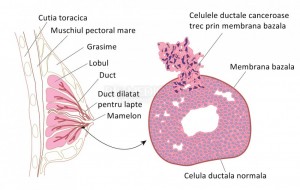 Cancerul de sân (mamar)