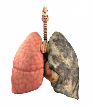 Cancerul pulmonar (bronhopulmonar, de plămâni)