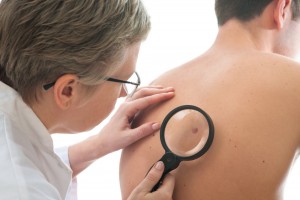 Alunițele și cancerul de piele