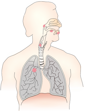 Carcinoidul pulmonar