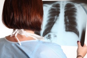 Cât de important este screening-ul pentru cancerul pulmonar?