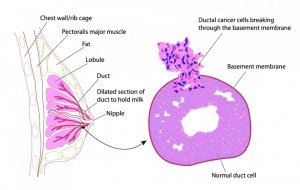 O posibilă explicație pentru recidiva cancerului mamar
