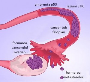 Cancerul ovarian își poate avea originile la nivelul tubilor falopieni