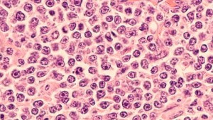O nanoparticulă sintetică induce moartea celulară în formațiunile canceroase