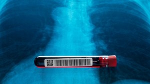 Un test de sânge împreună cu un model de risc determină precis cine ar putea beneficia de pe urma screeningului pentru cancer pulmonar