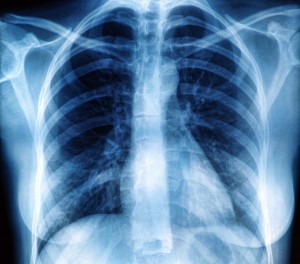 Un regulator epigenetic explică de ce unii pacienți cu cancer pulmonar devin rezistenți la terapiile convenționale