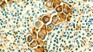 Terapia cu nanoparticule care vizează ganglionii limfatici pare a fi cheia în tratamentul cancerului de sân triplu negativ, conform unui nou studiu