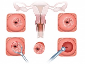 Cancerul vaginal