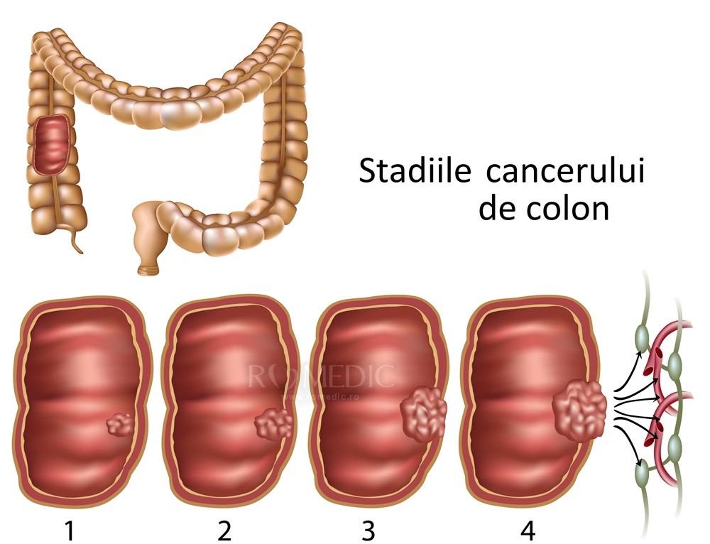 cancer de prostata gradul 3 forum