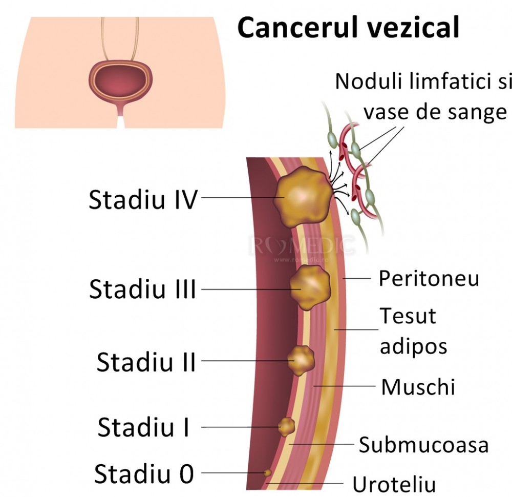 Cancerul de vezica – Spitalul Universitar de Urgenţă Militar Central Dr. Carol Davila