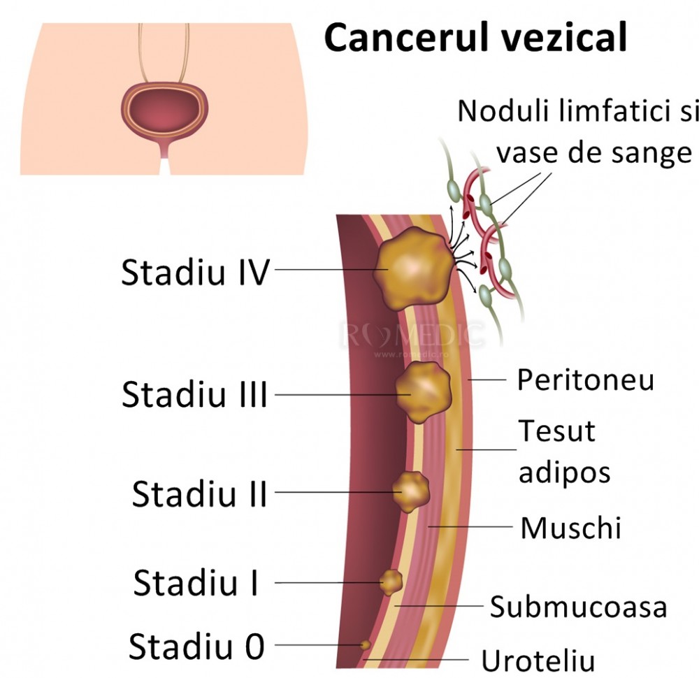 cancer vezica urinara vindecat