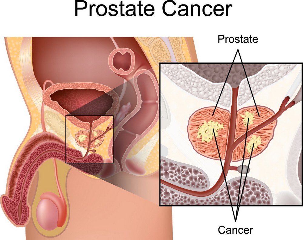 Cancer de prostată