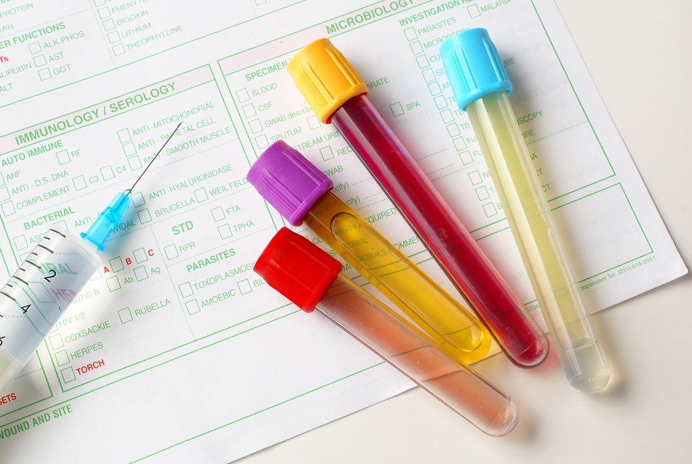 Eliminare Cheaguri De Sange In Urina Un test de sange si urina pentru detectarea cancerului renal | Ghid