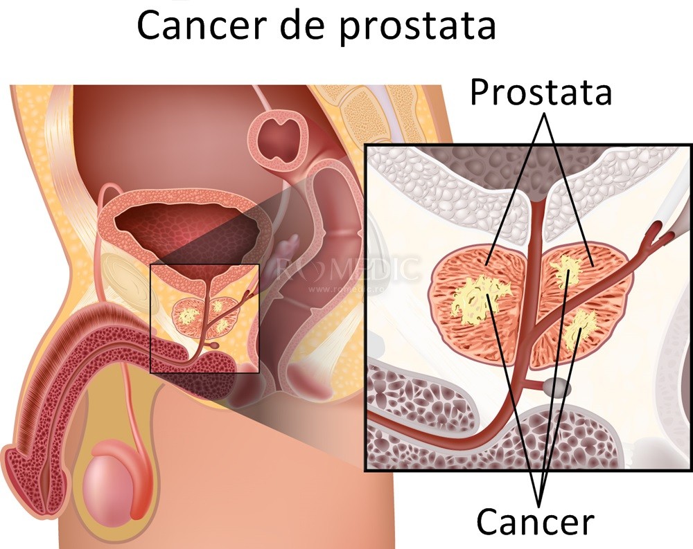 cu ce se trateaza cancerul de prostata)